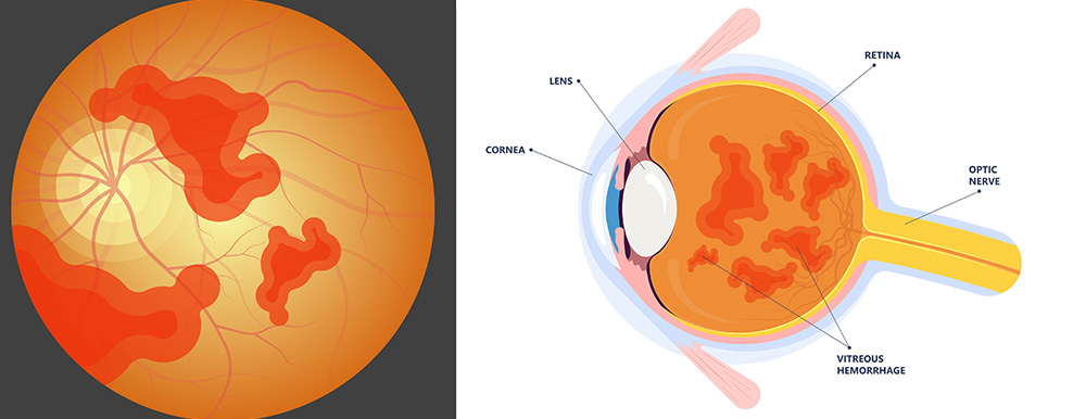 Hémorragie intra vitréenne