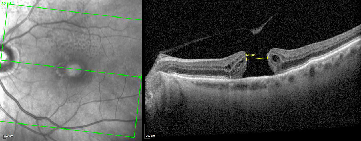 patient 85 ans 1.6/10